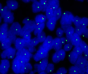 Individuelle Prognose durch genetische Analyse von Hirntumorzellen