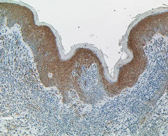 Tissue section of cutaneous T cell lymphoma. The nuclei are stained blue, PP4R1 brown. The subcutaneous T cells do not show any brown color and hence lack PP4R1.