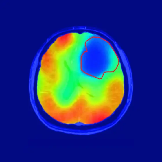 The red line delineates the tumor area; the colored contrast shows the oxygen metabolism. As predicted by Warburg’s theory, oxygen turnover in the tumor is reduced (blue).