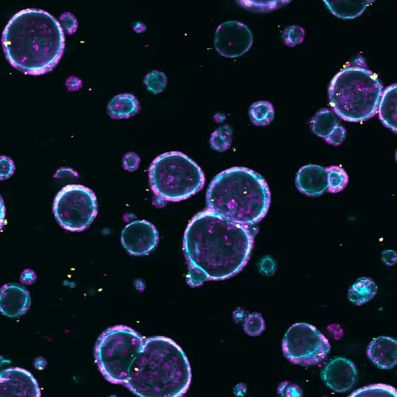 Mit Fluoreszenzmarkern angefärbte Organoide aus dem Gewebe von Darmkrebspatienten.