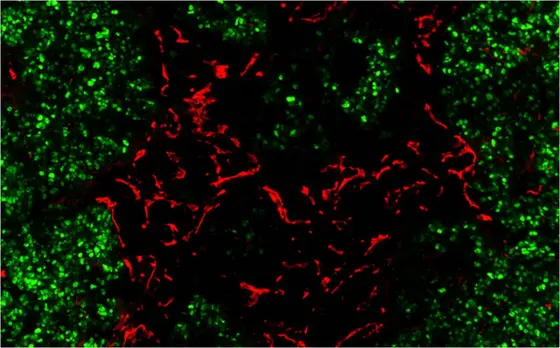 Red: A big problem for immunotherapy of cancer are blood vessels that are not properly formed. Green: Tumor cells