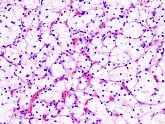 Beim klarzelligen Nierenkarzinom fanden Forscher vom DKTK Essen eine stumme Mutation mit großer Auswirkung auf die Prognose.