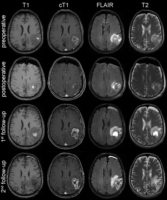 MRI scans during the course of the disease in a patient with glioblastoma