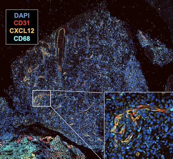 Dargestellt ist ein Gewebsstück eines Glioblastoms. Die Gefäße sind rot, der Botenstoff CXCL12 gelb gefärbt. Die Darstellung zeigt, dass der Botenstoff um Gefäße herum gebildet wird. Daher ist davon auszugehen, dass dieser Patient gut von der neuartigen Therapie profitieren wird.