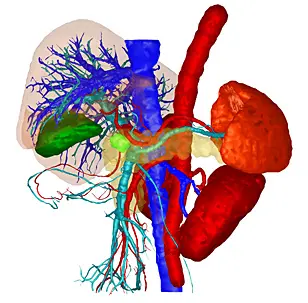 Räumliche Darstellung eines Bauchspeicheldrüsentumors (hellgrün, in der Bildmitte) sowie benachbarter Organe und Blutgefäße. Das 3D-Bild wurde mit einer Software erstellt, die Wissenschaftler am DKFZ entwickelt haben, um medizinische Bilddaten besonders effizient und genau auszuwerten. (Quelle: Mint Medical GmbH)