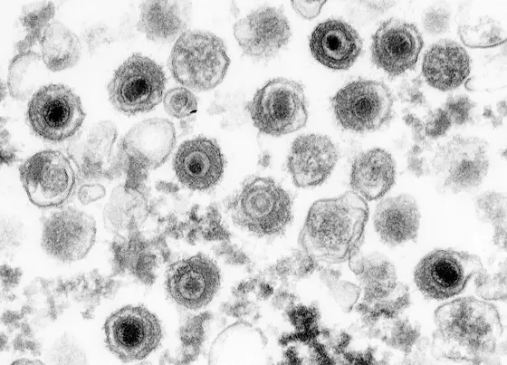 Electron micrograph picture of Epstein-Barr viruses