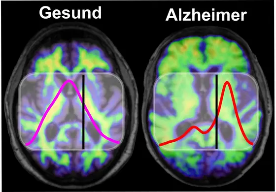 Im Gehirn von Menschen mit Alzheimer-Demenz kommt es zu krankhaften Ablagerungen des Proteins Amyloid-Beta, die mit bildgebenden Verfahren wie Amyloid-PET sichtbar gemacht werden können (rechts). Gesunde und krankhaft gefaltete Amyloid-Beta-Proteine absorbieren Infrarotlicht unterschiedlich. Bei Alzheimer-Patienten kommt es im Vergleich zu Gesunden zu einer Frequenzverschiebung unterhalb des Schwellenwerts, die der Bluttest nachweist.