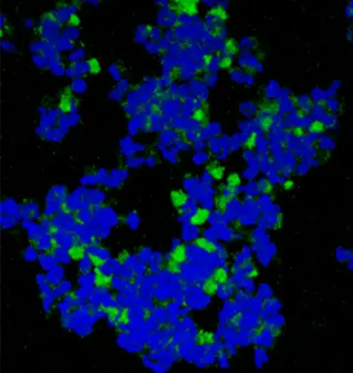 Die Kombination der beiden Wirkstoffe DMF und ABT-199 treibt Sézary-Zellen in die Apoptose (grün)