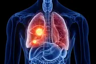 3d rendered medically accurate illustration of lung cancer Eine anatomische Darstellung eines menschlichen Körpers mit hervorgehobenen Lungen. Eine Lunge zeigt farbige Bereiche, die möglicherweise auf eine Erkrankung oder Anomalie hinweisen. Der Fokus liegt auf der funktionalen Struktur der Lungen und deren Bedeutung für die Atmung.
