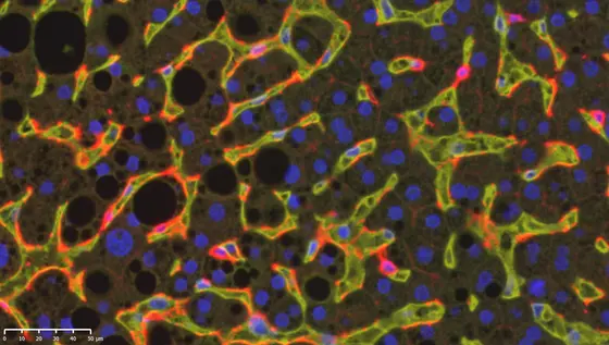 Immunfluoreszenzaufnahme einer menschlichen NASH-Leber: Die rot gefärbten DC1-Zellen patrouillieren durch die erweiterten Leberkapillaren (gelb). Fetttröpfchen sind als schwarze Kreise zu erkennen.