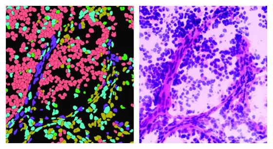 Microscopic image of the tumor cells, which develop differently depending on the tumor area. Right: Turquoise and beige cells are rapidly dividing, early tumor cells, green and red are more mature stages and purple are connective tissue and auxiliary cells of the tumor.