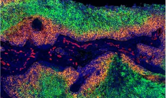 Cervical cancer: The tumor regions dyed green are deprived of oxygen. Here the cancer cells do not produce HPV-E7 (orange). Cell nuclei are marked in blue, blood vessels in red.