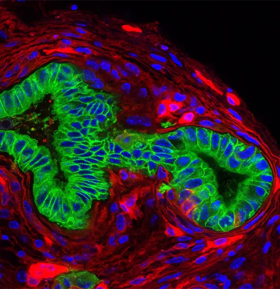 Pancreatic Carcinoma (green) in a mouse line with mutated Kras gene. Cells of tumor microenvironment are shown in red.