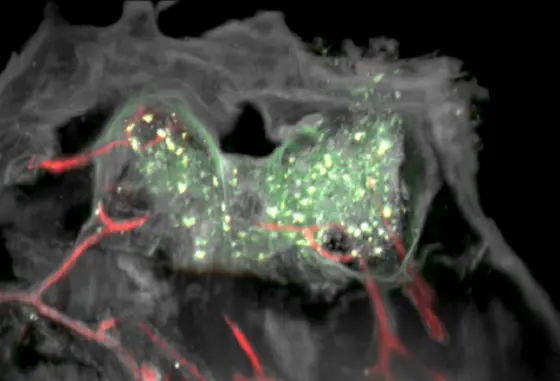 Skull bone (gray) of a patient with glioblastoma. Vessels (red) in the inner cavities of the local bone marrow; the immune cells, which are only found enriched in the immediate vicinity of the tumor, are shown in green.