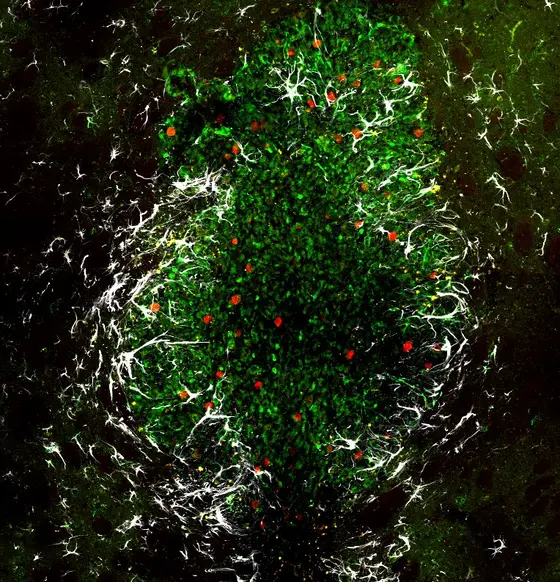 Tissue sample from a mouse brain showing a tumor generated from human glioblastoma cells. In green, tumor cells expressing EGFP, in red the proliferation marker Ki67 and in white the astrocyte marker GFAP.