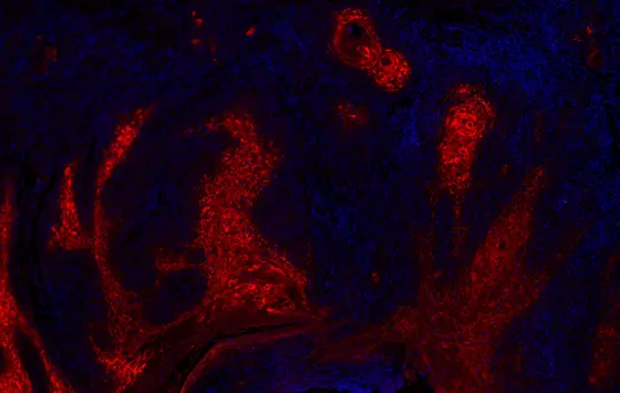 Plattenepithelkarzinom der Haut, das den Botenstoff Angiopoietin-like 4 (ANGPLT4) exprimiert