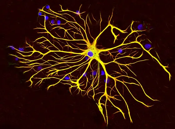 An astrocyte cell grown in tissue culture stained with antibodies to GFAP and vimentin.