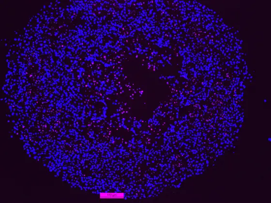 deficient cancer cells within the spheroids die from apoptosis (pink)