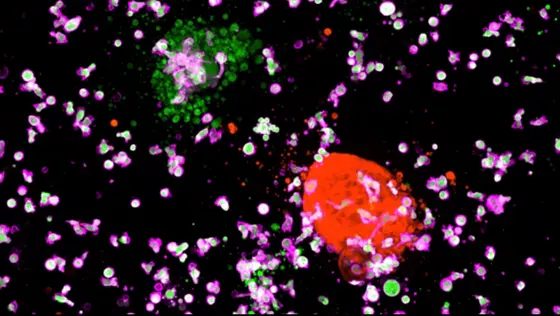 Angriff der Killerzellen: CAR-NK-Zellen (violett), die gegen ein krebsspezifisches Oberflächenprotein gerichtet sind, zerstören nur Darmkrebs-Organoide (grün) und verschonen Organoide aus gesunden Darmzellen (rot).