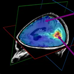 3D mapping of intracellular pH in a glioma patient