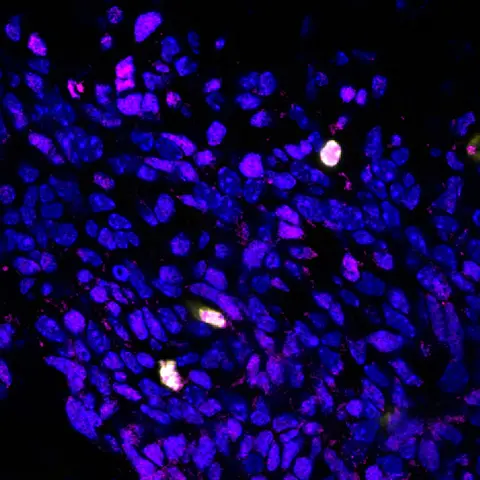 The picture shows the production of the protein BCOR (pink) in the brain cells of mice in which the gene Ptch1 is mutated. A particularly high amount of BCOR is produced in cells that are actively dividing (yellow).