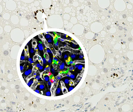 Mouse liver with non-alcoholic-steatohepatitis (NASH), platelets are stained brown. Magnification (immunofluroescence): Platelets (yellow) interact with Kupffer cells (green). The liver vessels are stained white, T lymphocytes red, nuclei of hepatocytes blue.