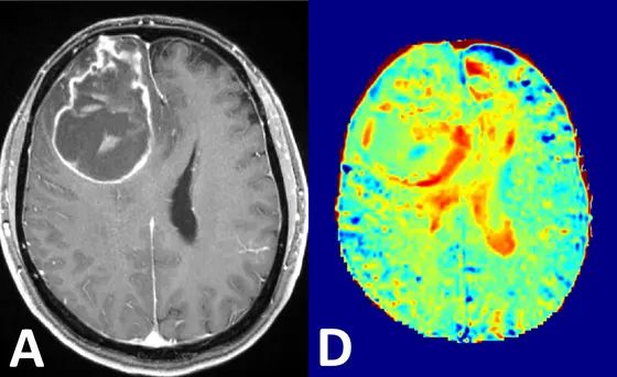 Links die Darstellung eines Hirntumors mit konventioneller, kontrastmittelverstärkter MRT, rechts die Glukose-MRT Bildgebung bei 7 Tesla.