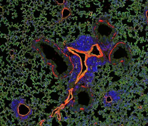 Metastatic growth in the lungs (mouse): Tumor cells (blue) grow around blood vessels in the lungs (red) to invade into the normal lung tissue (green).