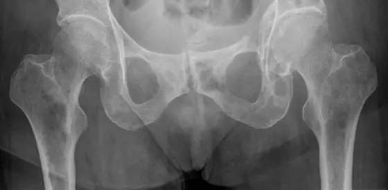 Breast carcinoma with osteolytic metastases