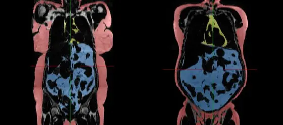 Both interval fasting and a conventional diet reduce the harmful visceral fat (right, marked blue). Subcutaneous fat (left, marked pink) is considered less risky for health.