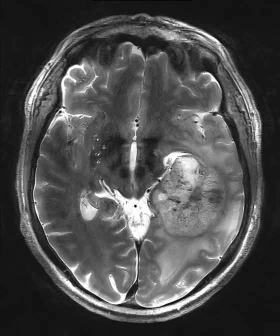 MRT-Image of a glioblastoma