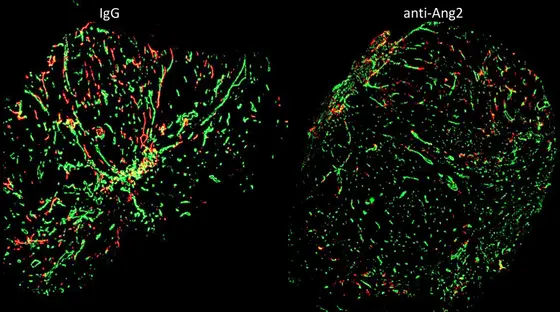 Histologische Aufnahme der Blutgefäße (grün) sowie der Lymphgefäße (orange) im Querschnitt eines Tumors. Rechts: Die Behandlung mit einem Angiopoietin-2-blockierenden Antikörper lässt die Tumorlymphgefäße absterben und unterbindet die Verbreitung von Tumorzellen über das Lymphgefäßsystem.