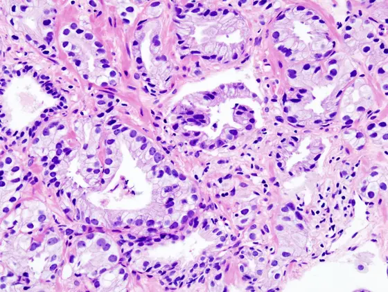 Light microscopic image of a prostate adenocarcinoma