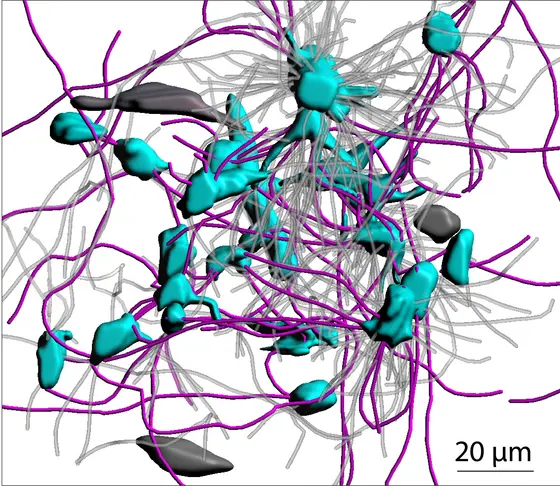 3D-Illustration of a glioblastoma: Interconnected tumor cells (blue) with the connecting microtubes (pink). Tumor cells and microtubes outside the network are grey