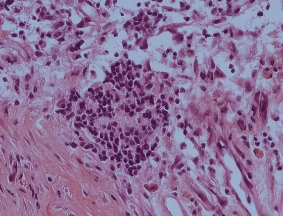 The histologic section shows an accumulation of aggressive neuroblastoma cells in the center of the image.