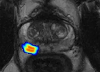 T2-gewichtetes MRT-Bild der Prostata, farbig markiert die durch das Neuronale Netzwerk generierte „Tumorwahrscheinlichkeitskarte“.