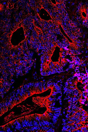 Tissue section of a colon carcinoma.