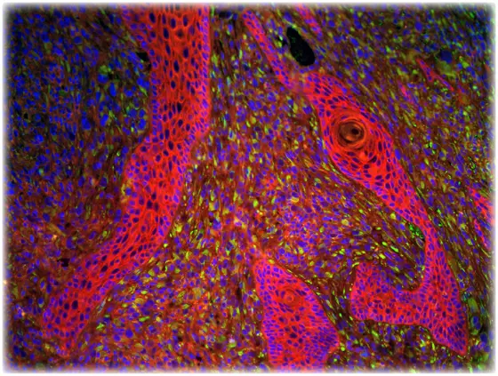 Plattenepithelkarzinom; E-Cadherin ist rot eingefärbt, Vimentin grün, die Zellkerne sind blau dargestellt.