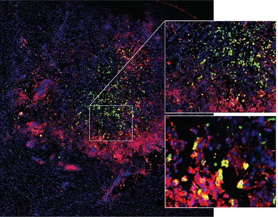 Microglia and macrophages migrate into a brain tumor and are reprogrammed during this process. Red: Activated state; green: immunosuppressive, "paralyzed" state, yellow: transition between activated and immunosuppressive state.