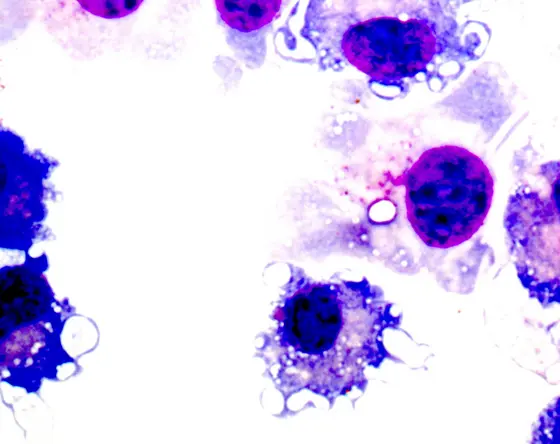 mds-Zellen (myeloid derived suppressor cells) unterdrücken die krebsspezifische Immunreaktion