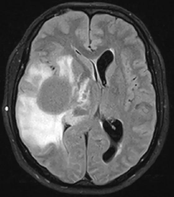 MRI image of diffuse glioma (top).