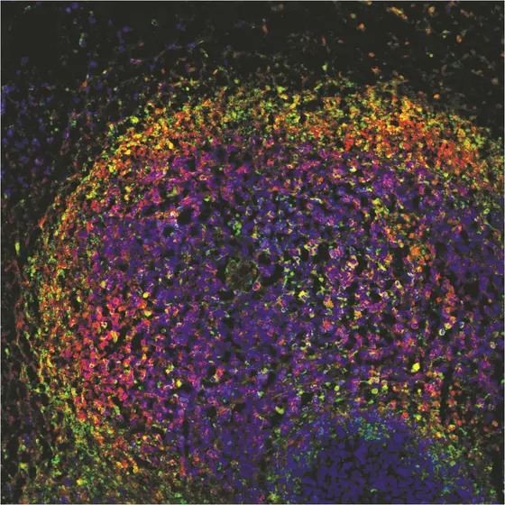 Immunfluoreszenzfärbung eines kutanes T-Zelllymphoms nach DMF-Behandlung: Bösartige Zellen sind rot, sterbende Zellen grün gefärbt. Stirbt eine Tumorzelle, überlagern sich die Farben und es kommt zu einer gelben Färbung. Die vielen gelben Zellen zeigen, dass das Medikament DMF die Lymphomzellen wirksam bekämpft. (Es handelt sich um Lymphomzellen des Menschen, die auf Mäuse übertragen wurden.)