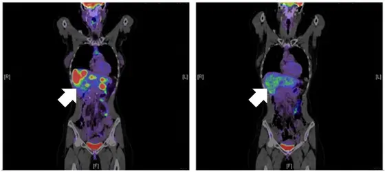 The HIV drug Maraviroc blocks the surface protein CCR5. This activates the macrophages in the liver to fight the metastases. In this patient, the metastases in the liver (left) disappeared following treatment (right).