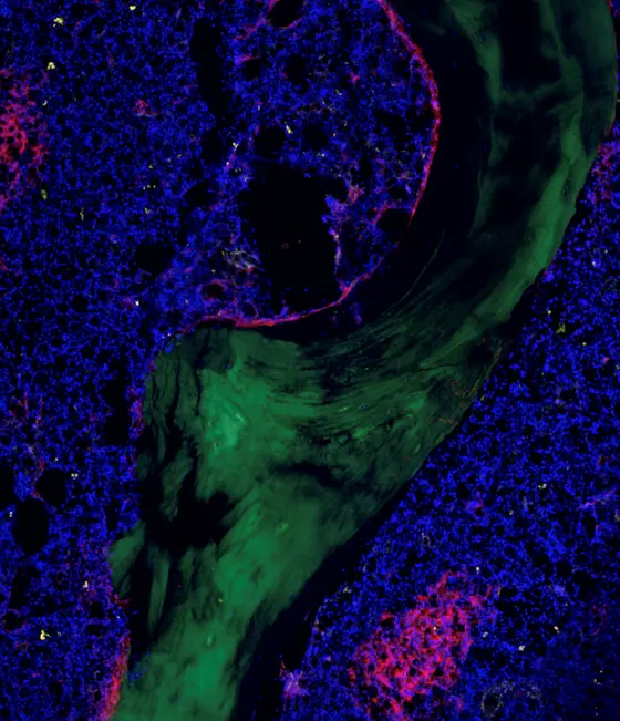 Leukaemia stem cells are located in a patient’s bone marrow (shown here in blue) in the so-called stem cell niche. The green structure is the bone itself.