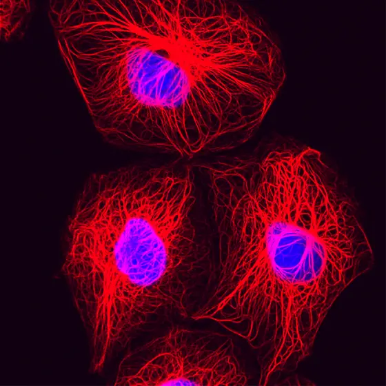 Breast cancer cells; proteins of the cytoskeleton are shown in red.