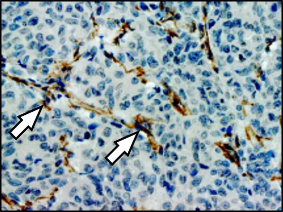 Lung metastasis in a breast cancer patient: the arrows indicate fibroblasts (brown) that communicate with metastatic cancer cells. Cell nuclei are stained blue.