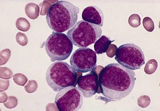 Agranular myeloblasts in a bone marrow smear from a patient with AML-M1 showing variation in size, amount of cytoplasm, and degree of cytoplasmic basophilia.