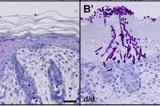 Der opportunistische Erreger C. albicans (violett gefärbt) durchdringt die Ceramid-defiziente Hautbarriere (rechts) der Hautbiopsie. R. Jennemann et al., 2012 Humanmolekulargenetik © Molekulargenetik des Menschen