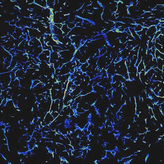 Mikroskopische Darstellung des dichten Netzes von Blutgefäßen in einem wachsenden Tumor.