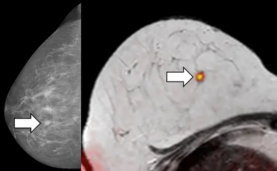 Der auffällige Befund der Röntgen-Mammographie (links) bestätigt sich bei der kombinierten diffusionsgewichteten Brust-MRT (rechts): Das orangefarbene Signal lässt auf einen bösartigen Tumor schließen. Eine anschließende Gewebeuntersuchung bestätigte das MRT-Ergebnis.